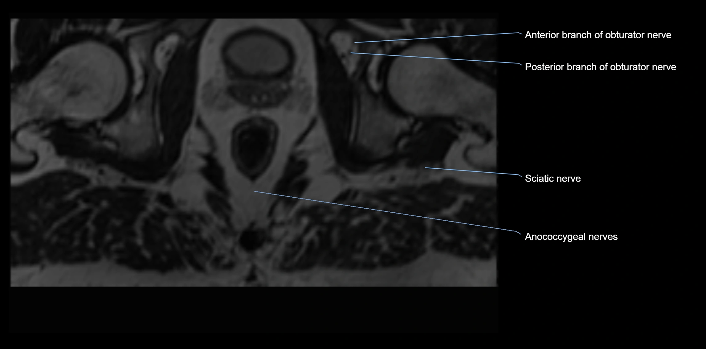 MR lumbosacral plexus axial cross sectional anatomy 3T  radiology  image-img-1008001-00130.webp